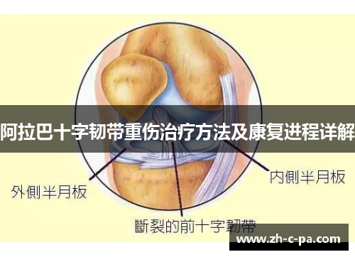 阿拉巴十字韧带重伤治疗方法及康复进程详解